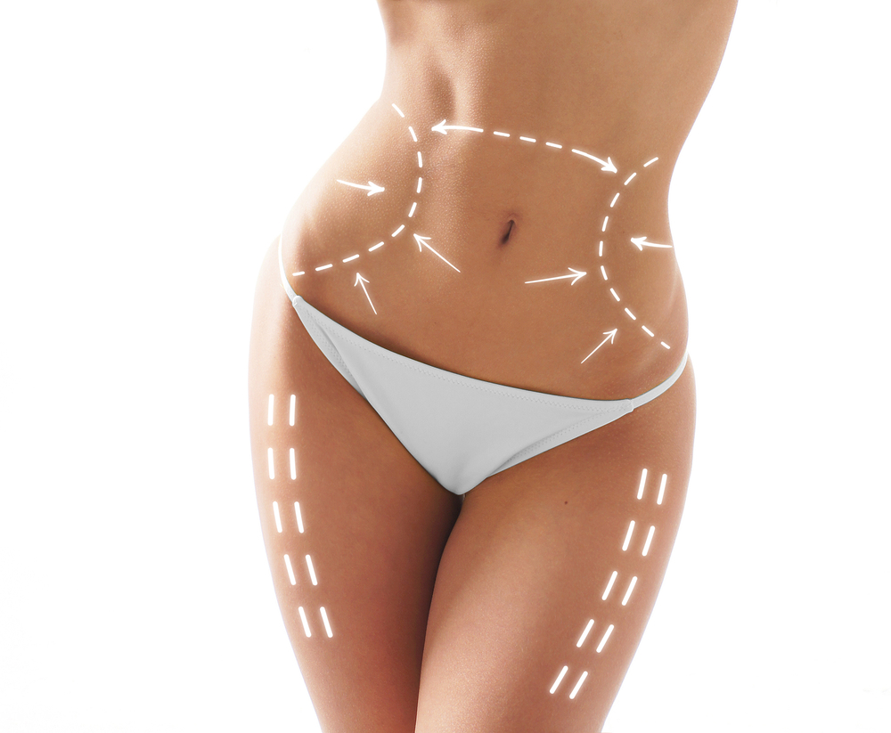 liposuction body